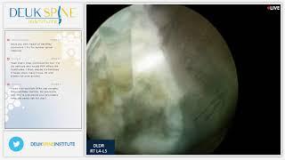 How Do You Know if You Have A HERNIATED DISC?! - Laser Spine Surgery
