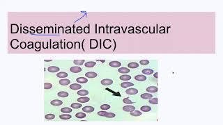 Disseminated Intravascular Coagulation( DIC)