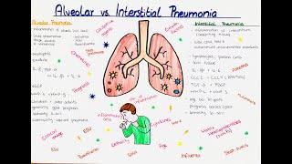 Alveolar vs Interstitial Pneumonia comparison