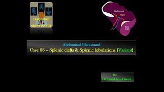Ultrasound Case 88 -Splenic Notch & Splenic Cleft )Normal Variant(
