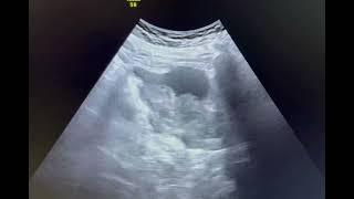 Ultrasound of ca bladder