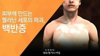 피부색 만드는 멜라닌 세포의 파괴, 백반증 - (2011.6.25_376회 방송)_藥인가! 毒인가! 자외선의 두 얼굴