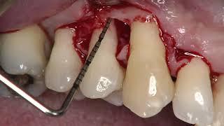 Single Flap Approach in combination with Enamel Matrix Derivative, Straumann® Emdogain®