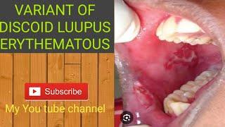 Skin disease (Varient of Discoid lupus erythematous)