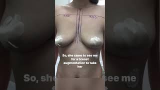 Breast Augmentation from B to D #shorts #breastimplantsurgery