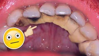 The most satisfying tartar cleaning | Belum Pernah Membersihkan Karang Gigi | Dokter Gigi Tri Putra