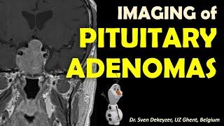 Imaging of Pituitary Adenomas