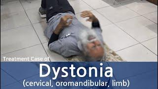 Dystonia / Cervical dystonia, Oromandibular dystonia, limb dystonia / 전신 디스토니아 치료사례 / 근긴장이상증