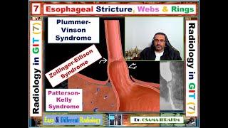 How to differentiate between sophageal stricture, webs and rings 7 radiology in GIT