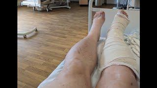 49 - I broke my leg - Update after Fawley Hill