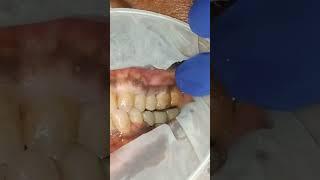 Lateral interferences checking for lower jaw molar implant bridge! ##shorts