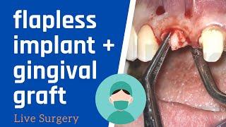 Flapless DENTAL IMPLANT SURGERY with connective tissue graft - LIVE