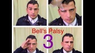 شاهد شلل الوجه النصفي  و التهاب العصب السابع (قبل العلاج) ! Bell's/Facial palsy BEFORE TREATMENT