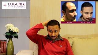 MR. RAB shares his hair transplant experience