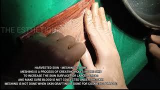 SKIN GRAFTING - HOW TO HARVEST A SKIN GRAFT | DR VICKY JAIN | PLASTIC SURGEON | COSMETIC SURGEON