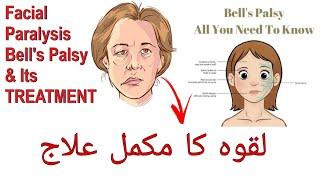 lakwa ka ilaj Urdu/Hindi | Bell's palsy exercise & Treatment