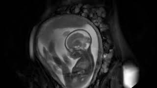 MRI scan at 28 weeks