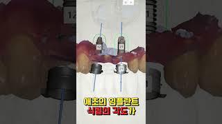 임플란트 부작용이 걱정되시나요? 앞니 임플란트가 망하는 이유!