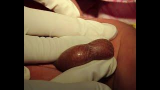 Retractile Testicles, How to be diagnosed easily by physical exam?
