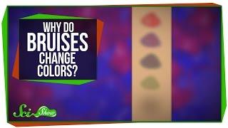 Why Do Bruises Change Colors?