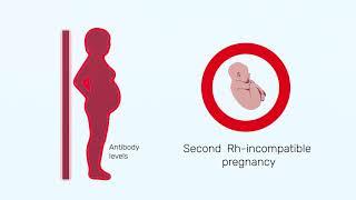 How Rh factor affects a pregnancy