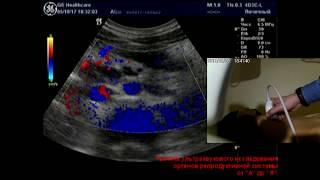 УЗИ при варикоцеле  и удвоении левой почечной вены и мезентеральной артерии  mp4