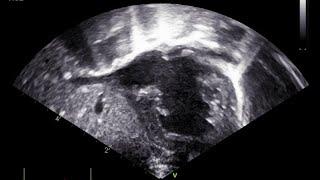 Echo of situs Ambiguous with a complex CHD