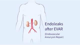 Endoleaks after Endovascular Repair of Thoracic Aortic Aneurysms (EVAR)