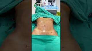 Abdomen Liposuction immediate result #shorts