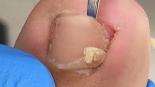 Very large ingrown nail removal process, shocking！【Xue Yidao】