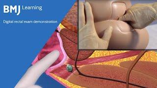 Digital rectal exam demonstration from BMJ Learning