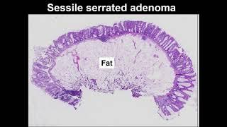 Serrated polyps Learn to tell the difference between hyperplastic polyp and sessile serrated lesion