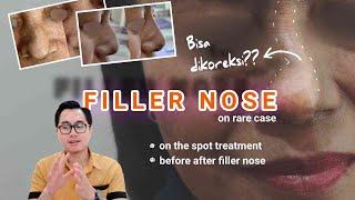 Straighten The Crooked Nose Without Surgery, Is It Possible? | Filler Nose Review dr.Irfan Prasetya