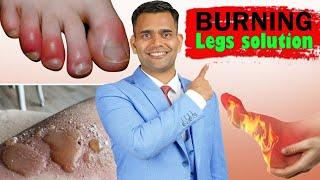 Burning Legs And Burning Feet Treatment and Herbs That Can Help