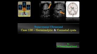 Ultrasound Case 138 - Germinolytic & Connatal Cysts