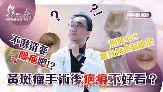 【美貌知尋識 ep49-黃斑瘤手術後疤痕不好看？】切除黃斑瘤疤痕會很難看嗎　#黃斑瘤 #台北黃斑瘤 #台北整外