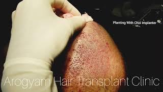 Best FUE Hair Transplant at Arogyam HT clinic Guwahati || Advanced Implanter technique for planting