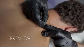 Extreme Trigger Point Release  |  Dry Needling  |  Painful!!!