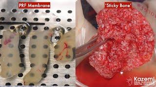 Platelet Rich Fibrin (PRF) Preparation for Membrane and Sticky Bone for Grafting