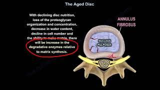 The Aged Disc   Everything You Need To Know   Dr  Nabil Ebraheim