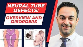 Neural Tube Defects: Overview and Defects