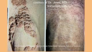 HPV BCR treatment Genital warts before and After photo