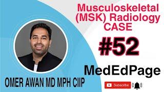 Musculoskeletal (MSK) Radiology CASE #52