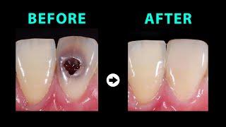 Trước và sau làm răng sứ | Before after restores bad teeth