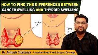 Differences Between Cancer Swelling and Thyroid Swelling | Thyroid Cancer | Kaizen Oncology Network