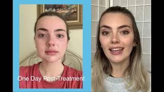 LM Buccal Fat Removal Testimonial