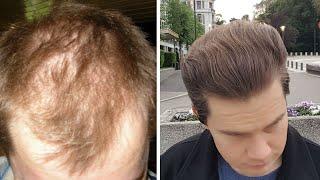 How To Distinguish Between Androgenetic Alopecia And Telogen Effluvium