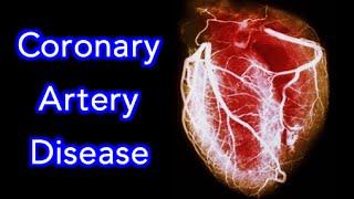 Coronary Artery Disease (CAD) Animation - MADE EASY