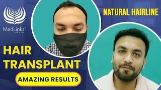 Successful Hair Transplant Results - 8 Months | Hair Transplant in India | MedLinks, Delhi