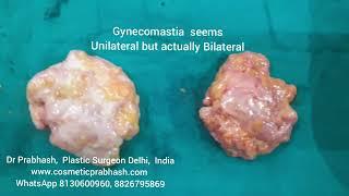 Gynecomastia surgery one side or both side Dr Prabhash Delhi